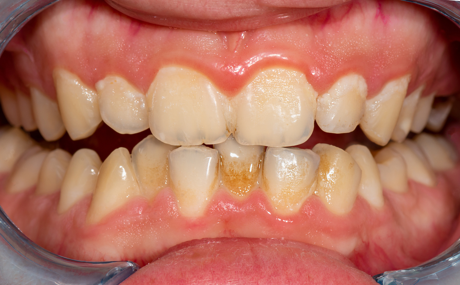 Plakkia ja ientulehdus