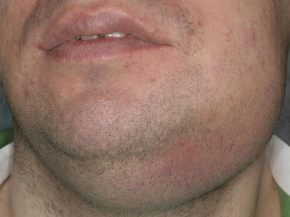 Alahampaasta levinnyt märkäpesäke