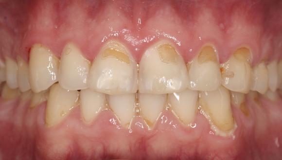 Hammaseroosio laakeita kuoppia